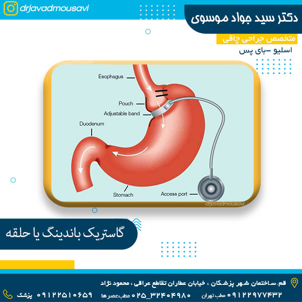 گاسترینگ باندینگ یا حلقه - دکتر جواد موسوی