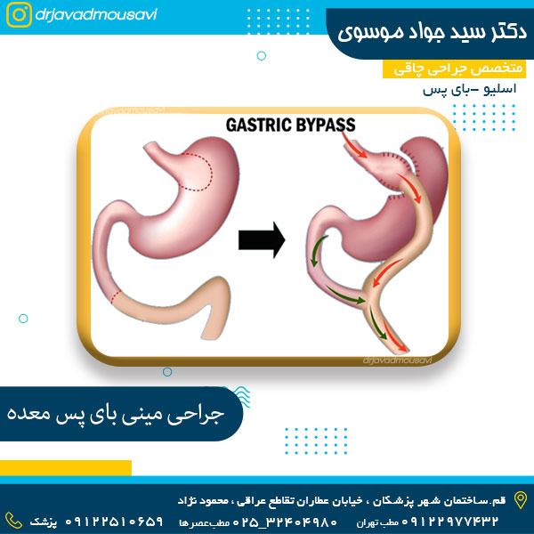 جراحی مینی بای پس معده - دکتر جواد موسوی 