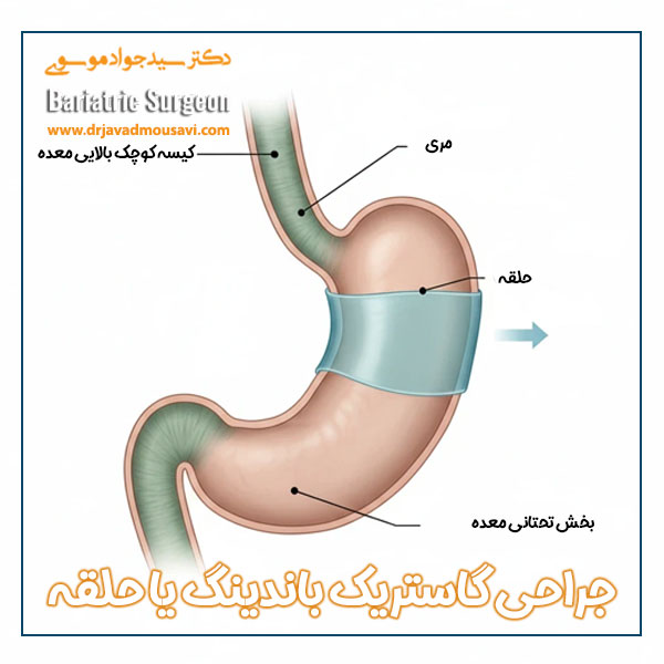 عمل گاستریک باندینگ یا حلقه در قم + دکتر جواد موسوی